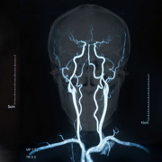 iStock 876410440 brain stroke x ray image