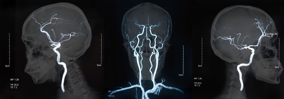 Global incidence of stroke is increasing at alarming rates, with new risk factors such as climate change and air pollution coming to the forefront.