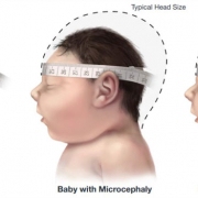 Babies with microcephaly have a smaller head than expected for their age and sex.