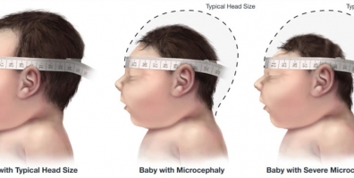 Babies with microcephaly have a smaller head than expected for their age and sex.